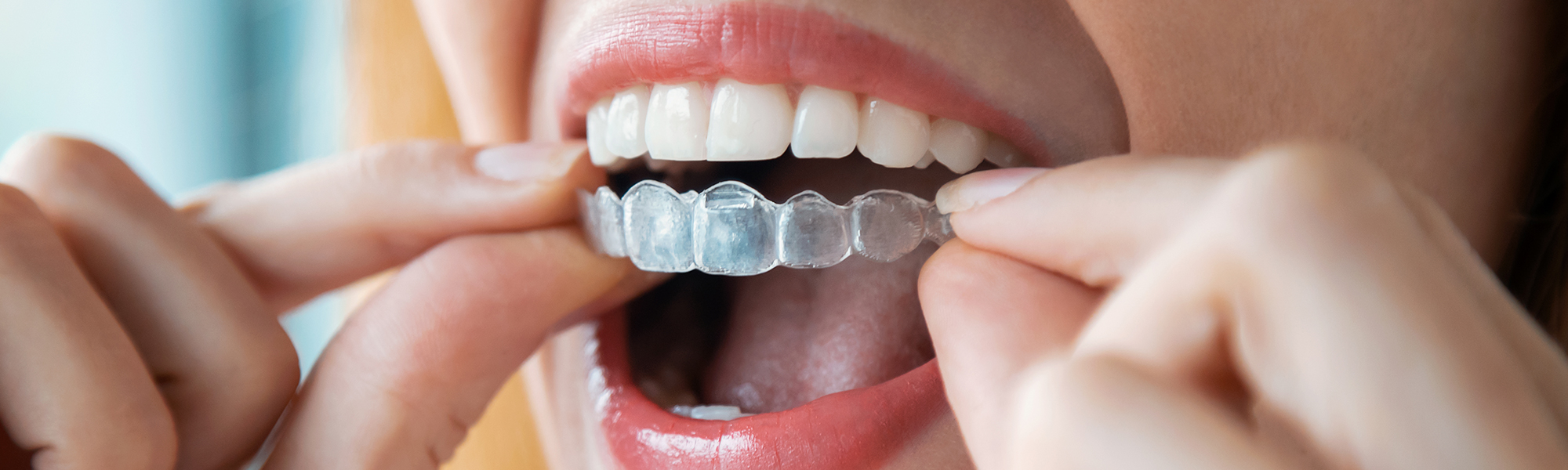 Invisalign Cerritos CA