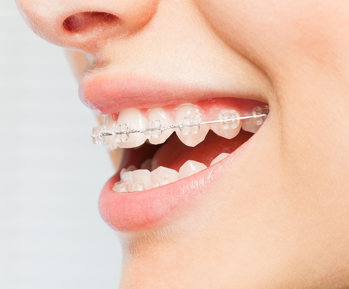 Porcelain Braces Cerritos CA