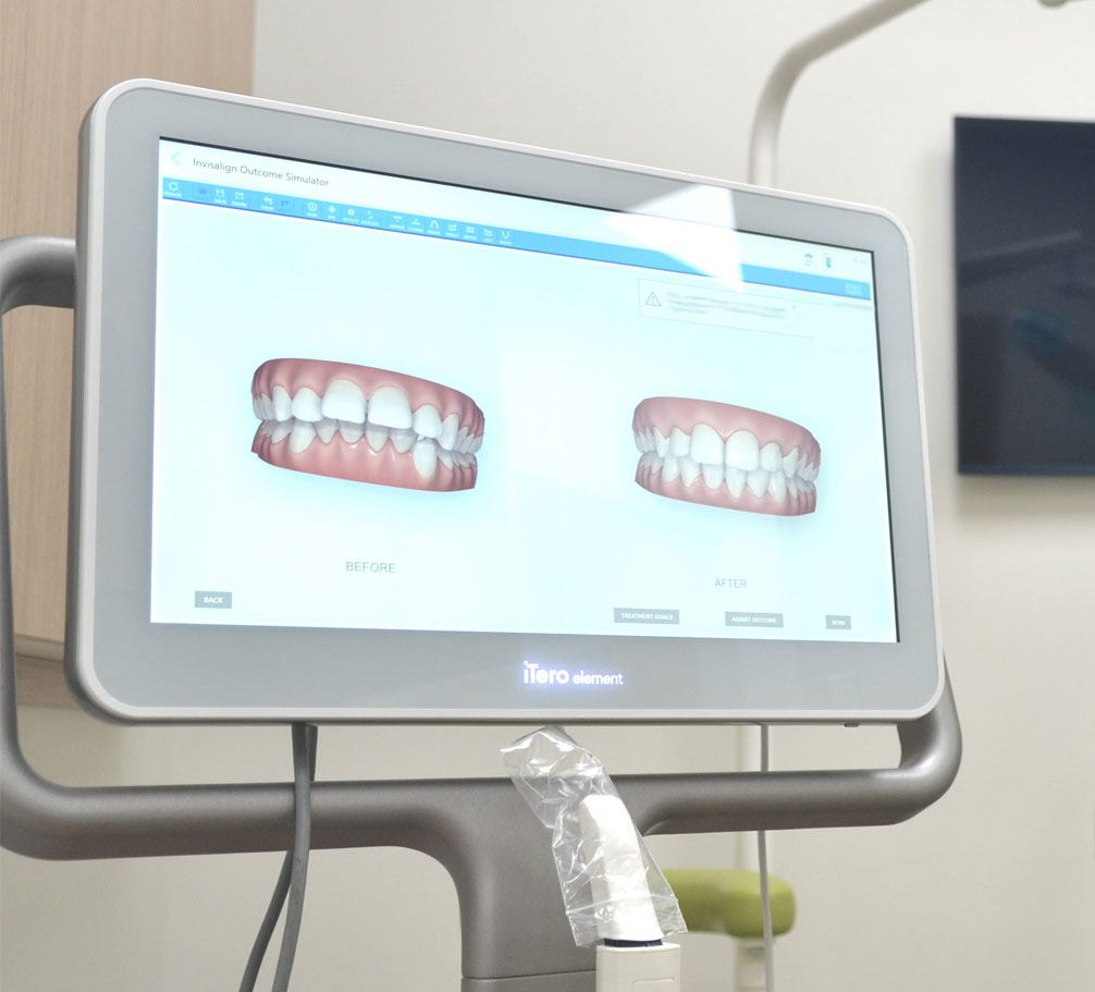 Invisible Braces Cerritos CA